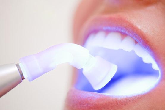 Tẩy trắng răng có hại gì với sức khỏe và những đối tượng không nên tẩy