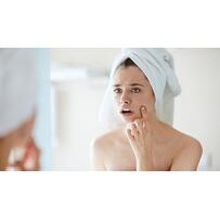 3 bí quyết trị mụn thâm cấp tốc cho cô dâu trước ngày cưới 3 bí quyết trị mụn thâm cấp tốc cho cô dâu trước ngày cưới