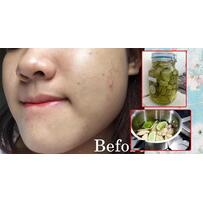 2 cách trị mụn ẩn hiệu quả nhất, da đẹp đón Tết hơn cả đống mỹ phẩm đắt tiền