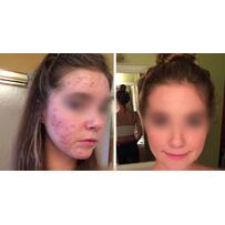 Chạy ra chợ mua rau diếp cá về làm theo cách này, mụn cứng đầu đến đâu cũng hết sạch