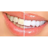 Còn ít ngày nữa là Tết, bỏ túi ngay các bí kíp tẩy trắng răng cực hiệu quả sau đây