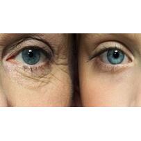 Đi tìm lời giải cho việc trẻ hóa làn da quanh mắt