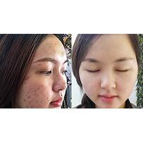 Điều trị mụn Dr. Huệ: Địa chỉ lấy nhân mụn, nặn mụn uy tín ở Gò Vấp TP.HCM