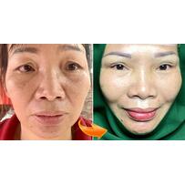 “Giải cứu” đôi mắt sụp mí bằng phương pháp treo chân mày Dr.Duy