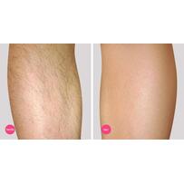 Hè rồi, đi biển chẳng dám mặc bikini vì chân nhiều lông, hãy áp dụng ngay 2 công thức này