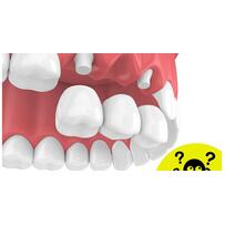 Lý giải vì sao trồng răng sứ 1 răng phải làm thành 3 răng