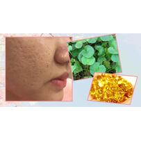 Mặt rỗ như tổ ong bầu cũng được lấp đầy nếu bạn làm việc này mỗi tối