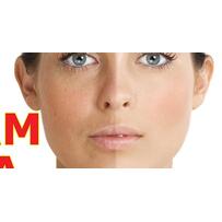 Melasma - giải pháp chăm sóc da toàn diện cho phái đẹp