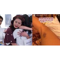 Minh Tú bị vỡ mạch máu, da nổi nhiều vết bầm tím, chị em cũng nên cẩn thận!