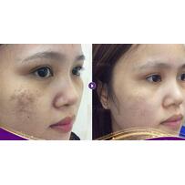 Mùa đông - "thời điểm vàng" trị nám cho chị em