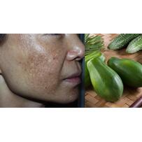 Nám nặng cỡ nào cũng biến mất nhờ 2 cách dễ ợt từ đu đủ xanh