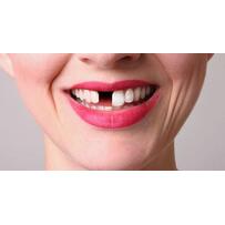 Ngay bây giờ đã có giải pháp trồng răng cửa vĩnh viễn