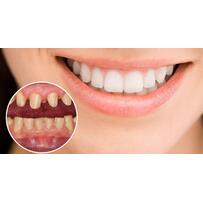 Những điều bạn nhất định phải biết trước khi tiến hành bọc răng sứ