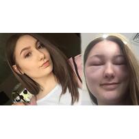 Nhuộm tóc không cẩn thận, mặt bạn sẽ biến dạng, mất thị lực thậm chí tử vong như chơi đấy!