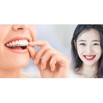 Niềng răng thẩm mỹ và những điều bạn nên cần biết