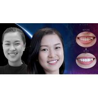 San Dentist khắc phục cười hở lợi chỉ với 5 bước