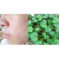 Sẹo thâm, sẹo lõm đến cỡ nào cũng được san phẳng với công thức chưa đến 5 ngàn đồng