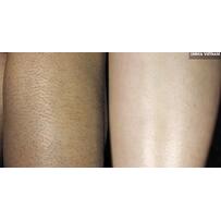 Thực hư việc triệt lông bằng mỡ trăn ngay tại nhà