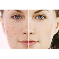 Cách trị thâm mụn đơn giản, hiệu quả tại nhà