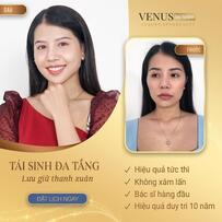 Lên đời nhan sắc nhờ giải pháp trẻ hóa khuôn mặt Tái sinh đa tầng Lên đời nhan sắc nhờ giải pháp trẻ hóa khuôn mặt Tái sinh đa tầng