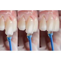 Lý do dán sứ Veneer được ưa chuộng