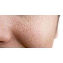 Mụn ẩn là gì? Có cách nào loại bỏ "triệt để" không?