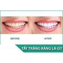 Tẩy trắng răng có hại gì với sức khỏe và những đối tượng không nên tẩy